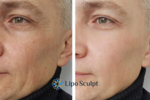 How to Fight Aging Symptoms 3 Fight Aging Symptoms Newham With HIFU and Morpheus8 Today!