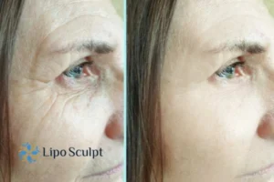 How to Fight Aging Symptoms 2 Do you want to Fight Aging Symptoms Newham? Contact Lipo Sculpt today!