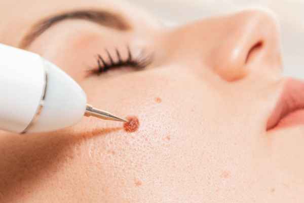 CryoPen: 5 Skin Concerns It May Be Used to Treat 3 What actually happens during a CryoPen treatment Newham?