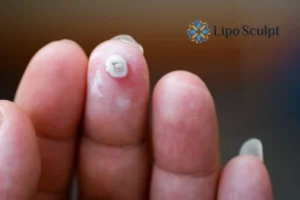 Cryopen Top 5 Treatable Conditions 4 Do you have a persistent wart of verruca that you cannot shit? Cryopen Newham treatment will work call us NOW!