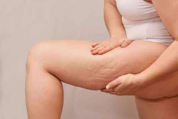 Find the best cellulite treatment Newham for you!