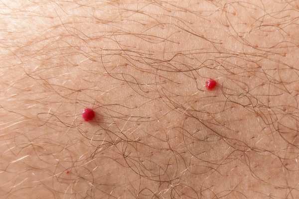 CryoPen: 5 Skin Concerns It May Be Used to Treat 2 cherry angioma removal Newham