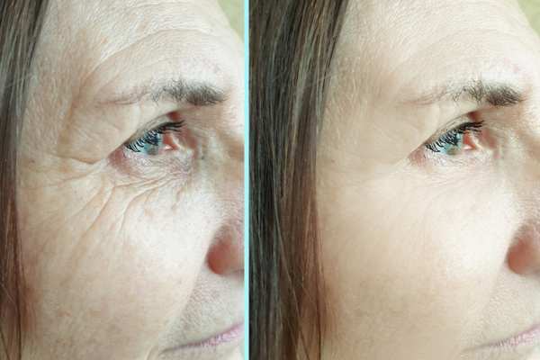 Why Do People Choose HIFU for a Non-Surgical Facelift? 4 How long can HIFU results last Newham?