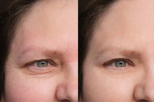 HIFU vs Botulinum Toxin: Understanding the Differences 4 How long do HIFU results last Newham?