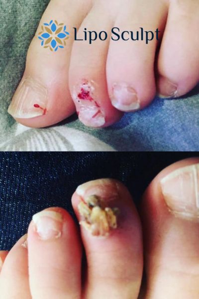 Wart removal customer results from Lipo Sculpt Newham