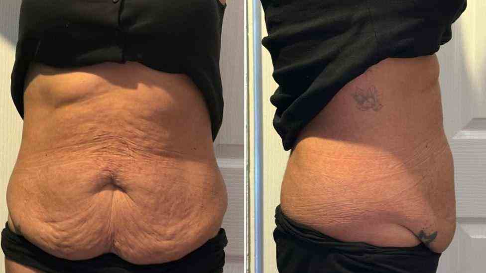 Lost the Weight but Not the Loose Skin? What You Should Know 1 Is It Definitely Loose Skin Newham?