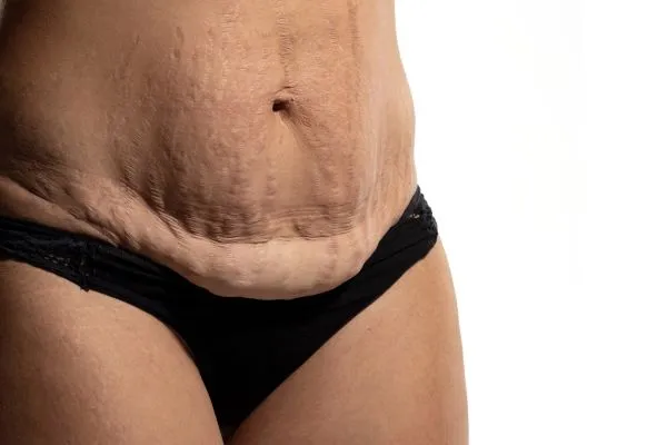 Lost the Weight but Not the Loose Skin? 1 image of womans stomach after weight loss showing loose skin Newham